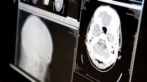 5 months following diagnosis. . When to stop treatment for glioblastoma